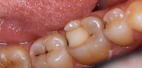 العلاجات الشعبية لألم الأسنان سريع