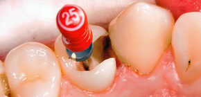 لماذا وجع الاسنان بعد علاج التهاب لب السن ، وهل من المؤلم العض؟