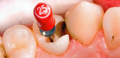 لماذا وجع الاسنان بعد علاج التهاب لب السن ، وهل من المؤلم العض؟