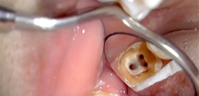 حول علاج الأسنان pulpitis ثلاثة قنوات وأسعار لهذا الإجراء
