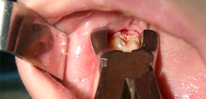 Възможни усложнения след процедурата за извличане на зъбите