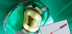 Was tun, wenn ein Zahn nach Nervenentfernung und Kanalreinigung schmerzt
