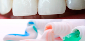 Wie wählen Zahnpasta aus Karies: Wir wählen die beste Option