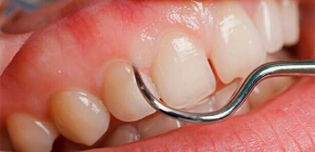 Kariesgefahr unter dem Zahnfleisch und Merkmale seiner Behandlung