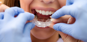 Orthodontische Kappen zur Bisskorrektur