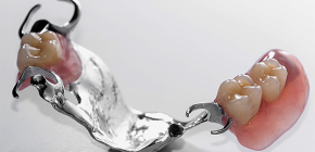 Klammerprothese der Zähne und ihrer Varietäten