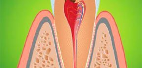 Symptome der Pulpitis: Was ist wichtig zu wissen mit starken Schmerzen im Zahn