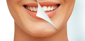 Τι λεύκανση των δοντιών είναι η ασφαλέστερη και πιο σμάλτο φιλική;