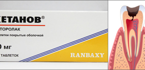 Ketanov tablets for relieving toothache and reviews of their use