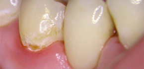 Details about caries and the causes of its development