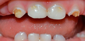 What is important to know about caries of milk teeth in young children