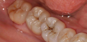 How to recognize dental caries: the main methods of diagnosis