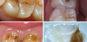 How caries can look on teeth: photos