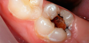 Classification of pulpitis from the point of view of a practicing dentist
