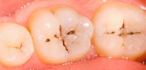Chronic caries in adults and children