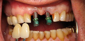Is it possible to implant teeth with periodontitis and periodontal disease?