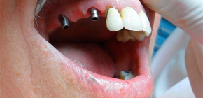 Complications and problems that sometimes arise after dental implants