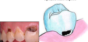 Treatment of cervical caries