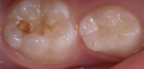 Features of diagnosis and treatment of dentin caries