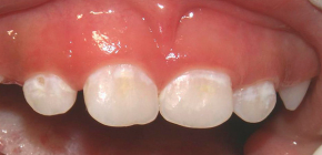 Treatment methods for initial caries in the white spot stage
