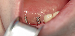 Modern types of dental implants and standard prices for this procedure