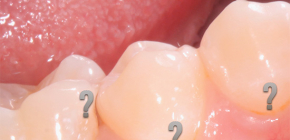 Details about the hidden caries, as well as its examples in the photo