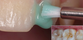Treatment of caries at home: is it really possible?