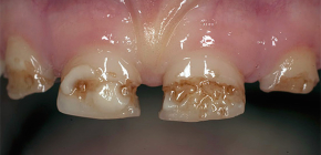 About neglected caries: what to do if almost all teeth have signs of destruction