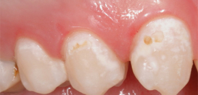 Initial caries in the staining stage and its treatment