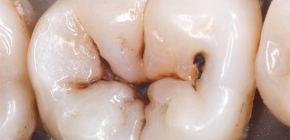 Features of fissure caries: from diagnosis to treatment