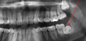 Impacted wisdom teeth and their removal (when they cannot erupt)