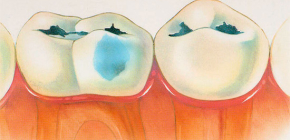 Tooth decay in decompensated form