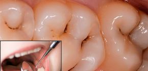 How are caries in dentistry treated today?