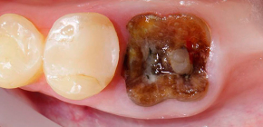 Tooth root removal (when the coronal part is destroyed, or there is inflammation on the root)