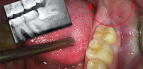 What to do if a wisdom tooth grows and your gums hurt?