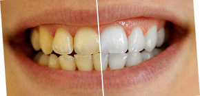 How can you whiten your teeth at home without harm to enamel
