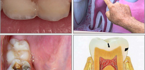 What is dental caries