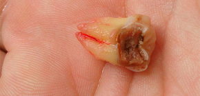 Extraction of the wisdom tooth located on the lower jaw