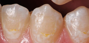 Enamel caries: from diagnosis to treatment methods