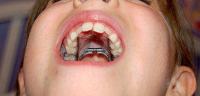 Orthodontic appliances for correcting bite in children