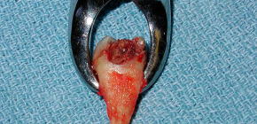 Extracción de dientes: cómo prepararse para el procedimiento y sus pasos principales.