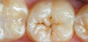 Cómo proteger los dientes de la caries: una revisión de los métodos efectivos
