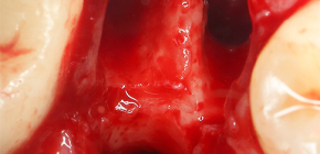 ¿Cómo se puede detener la sangre después de la extracción del diente?