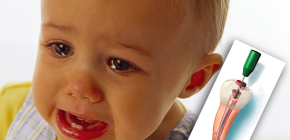 Tratamiento de la pulpitis en dientes de leche en niños.