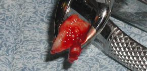 Interesantes detalles de la extracción de muelas del juicio en la mandíbula superior.