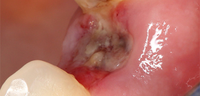 दाँत निष्कर्षण के बाद एक जटिलता के रूप में Alveolitis (जब छेद festered)