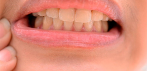 गंभीर दांत दर्द से छुटकारा पाने के लिए घर पर क्या किया जा सकता है