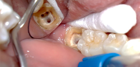 दांत की लुगदी क्या है: कारण और संभावित खतरे