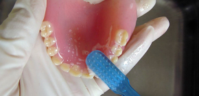 हटाने योग्य दांतों के लिए देखभाल की शर्तें