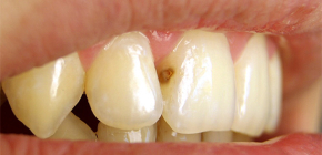 Cosa fare se compare la carie sui denti anteriori